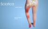 Sciatica